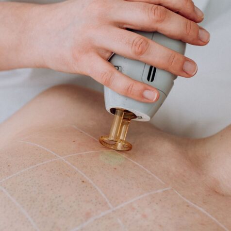 bonos depilación láser alejandrita